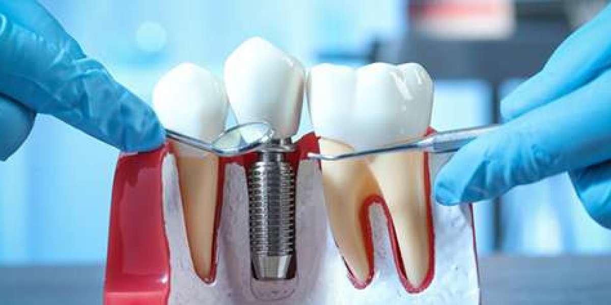 Do Dental Implants in Dubai Require Special Maintenance or Cleaning?