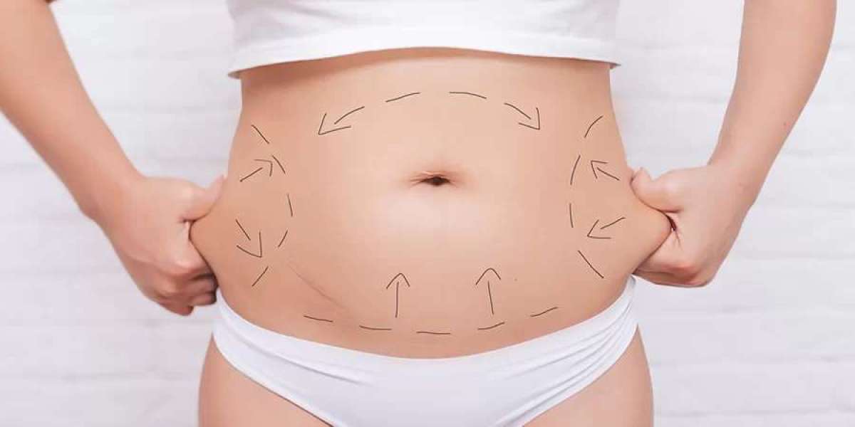 Step-by-Step Guide to Getting a Tummy Tuck in Islamabad